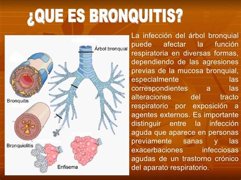 que es bronquitis